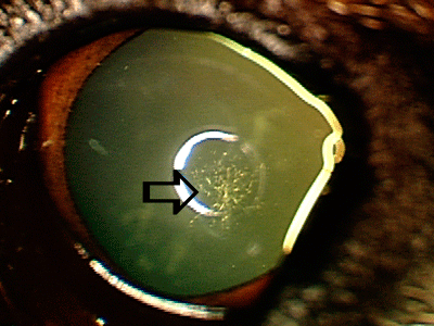 small hereditary catarac